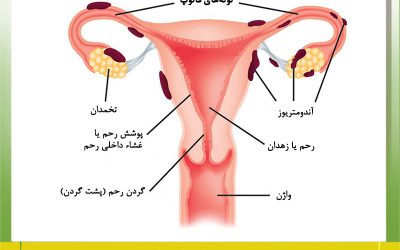 درمان آندومتریوز در ساری