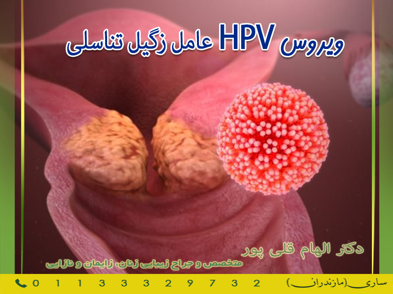 ویروس HPV عامل زگیل تناسلی
