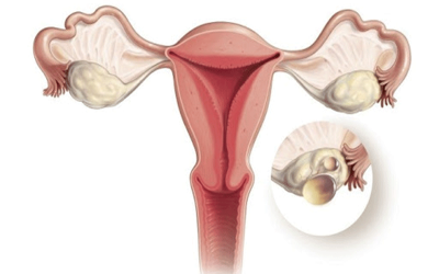 درمان قطعی تخمدان پلی کیستیک
